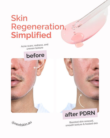 Real before and after using Next Skin PDRN for skin tone